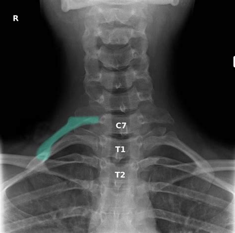 thoracic outlet syndrome x ray